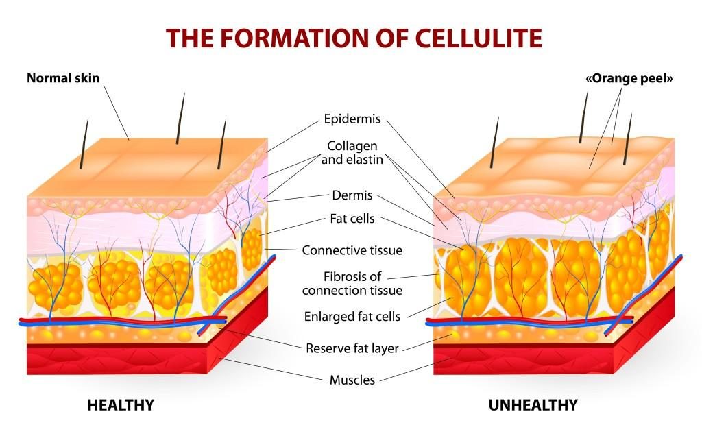 cellulite cool sculpting