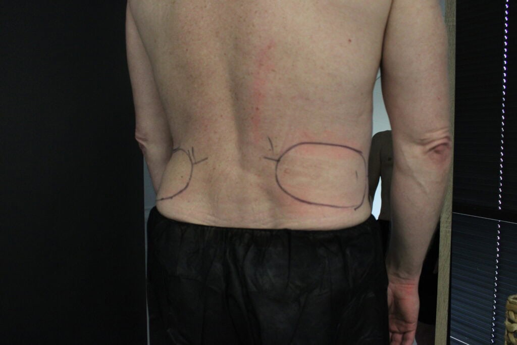 Male CoolSculpting client with treatment markings