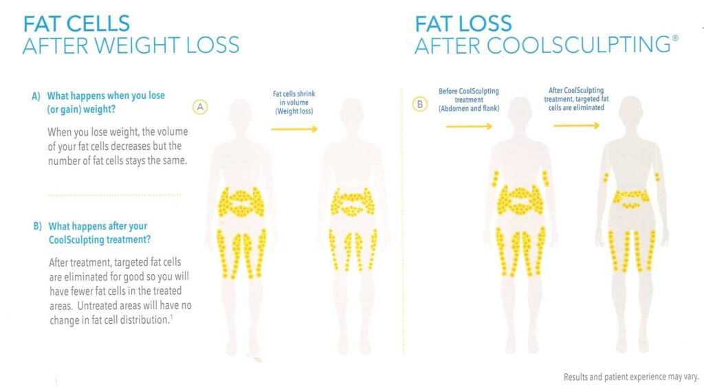 How Much Fat you can lose with CoolSculpting