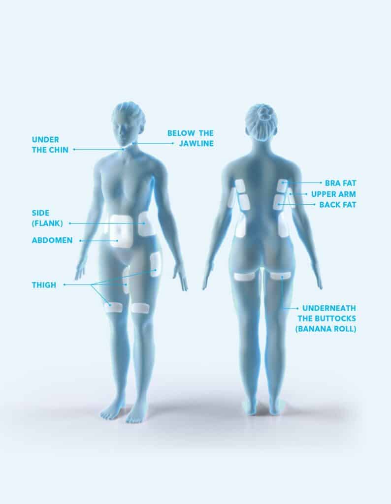 what areas can coolsculpting treat diagram