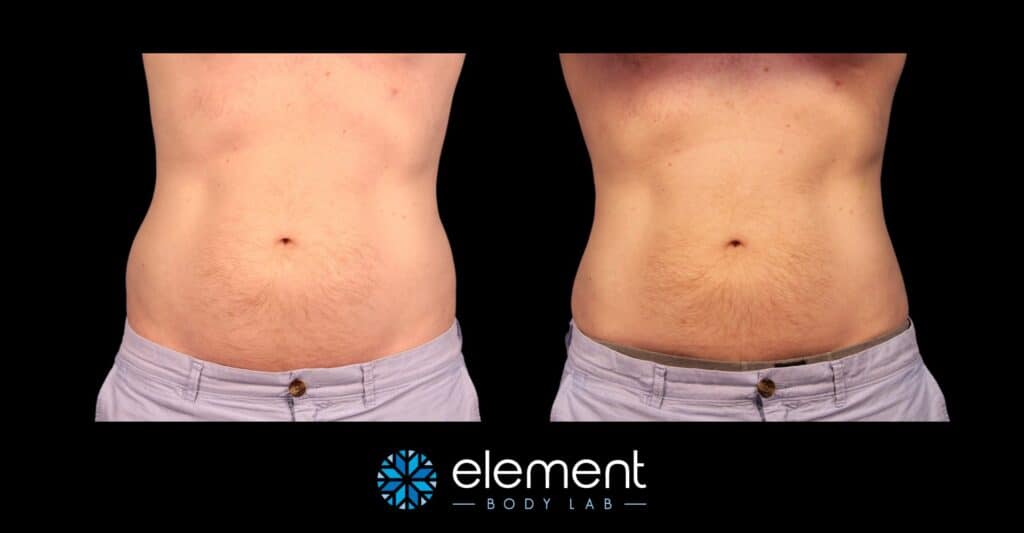 CoolSculpting before and after result on male love handles