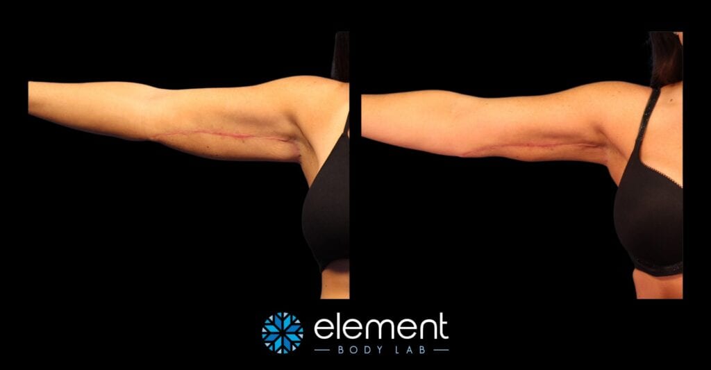 upper arm coolsculpting results after a brachioplasty