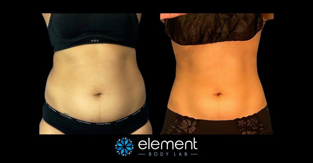 Female CoolSculpting client stomach results after 2 rounds of CoolSculpting Elite with Element Body Lab