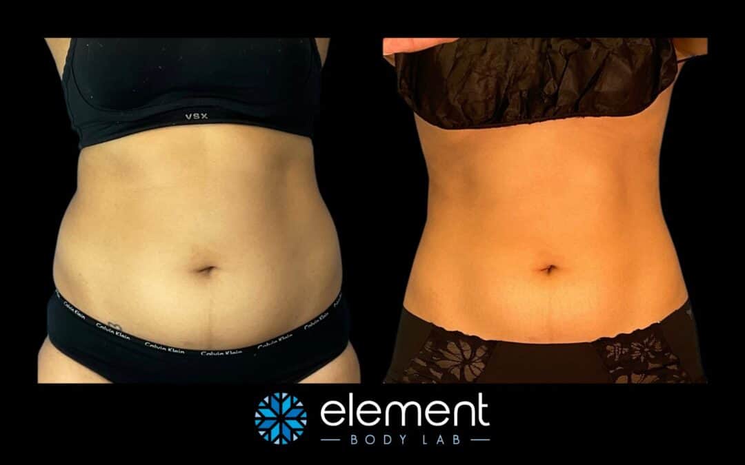 COOLSCULPTING BEFORE AND AFTER IMAGES - Advanced Body Sculpting