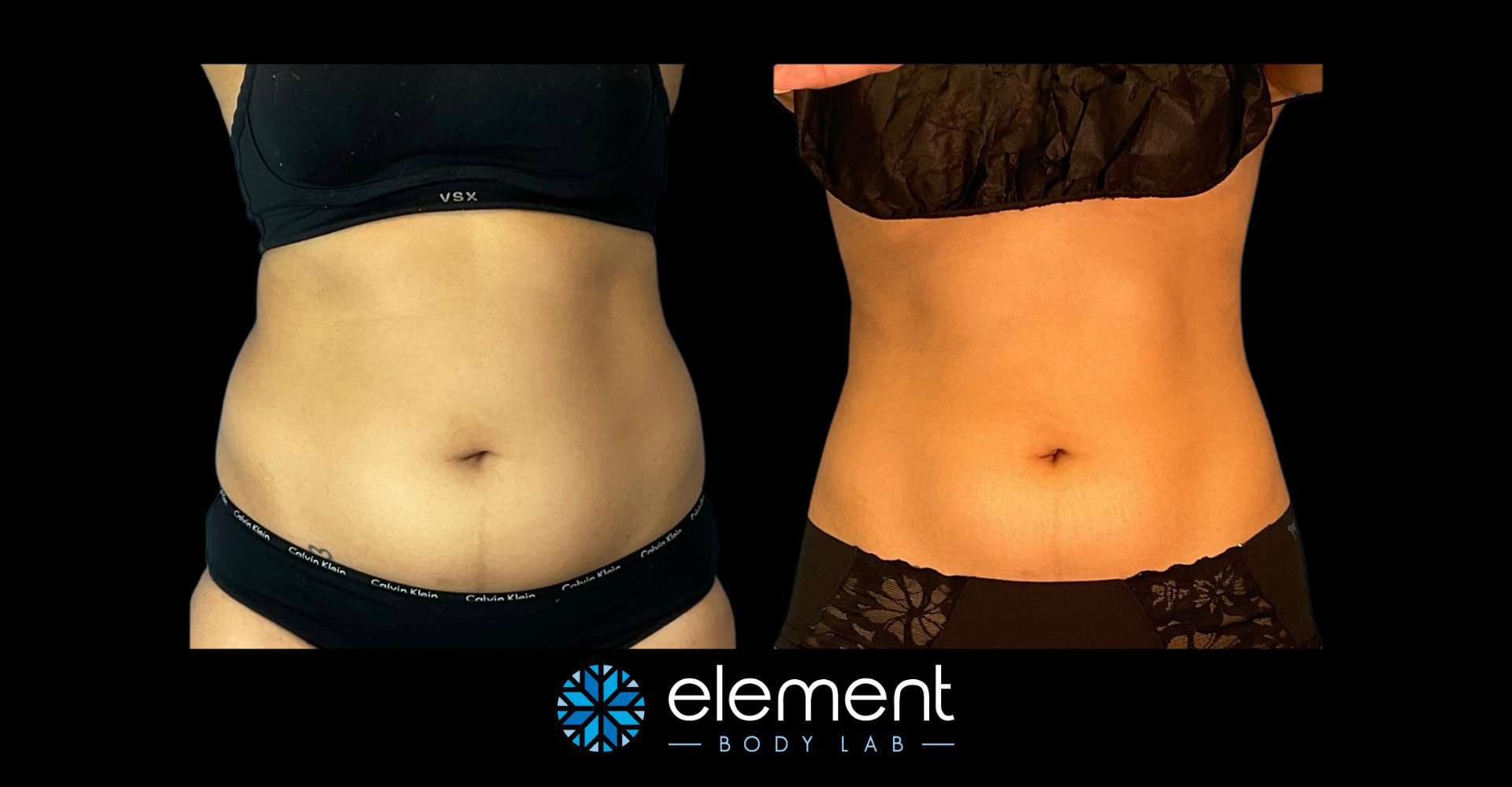 Coolsculpting Results in Dallas, TX – Before and After Photos
