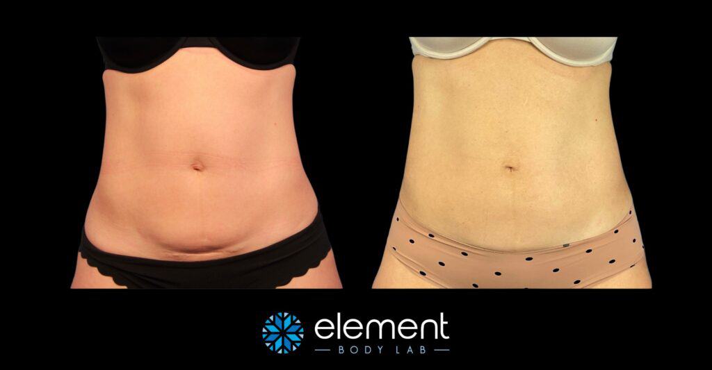 Sculpting a Smaller Waist with CoolSculpting Before & After Photos