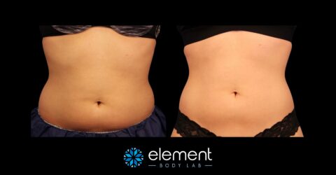 Sculpsure vs CoolSculpting - Element Body Lab