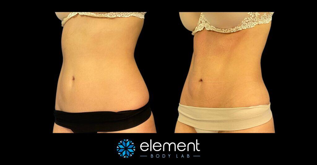before and after coolsculpting results on stomach