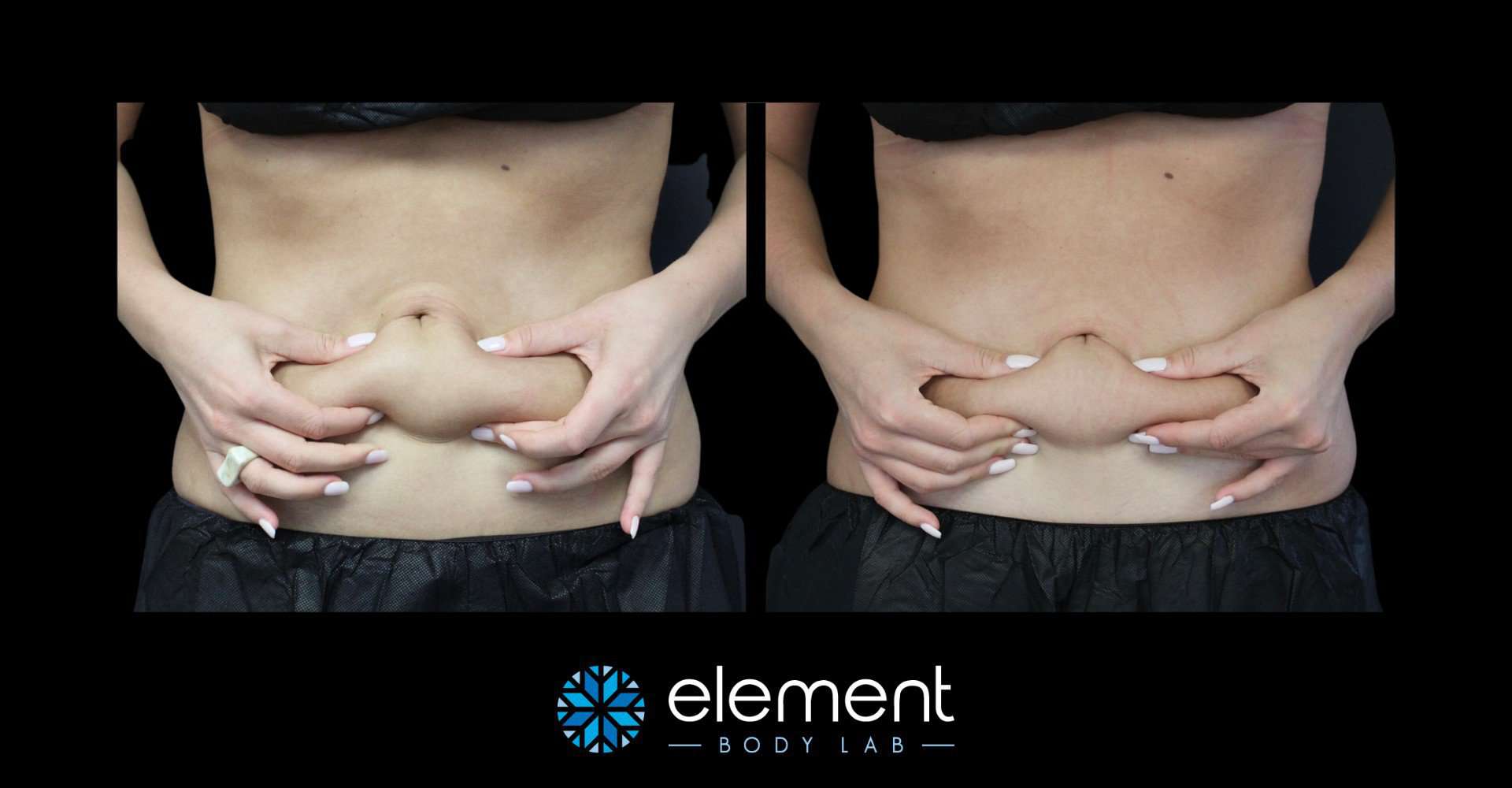 CoolSculpting Before and After Picture of Female Lower Abdomen