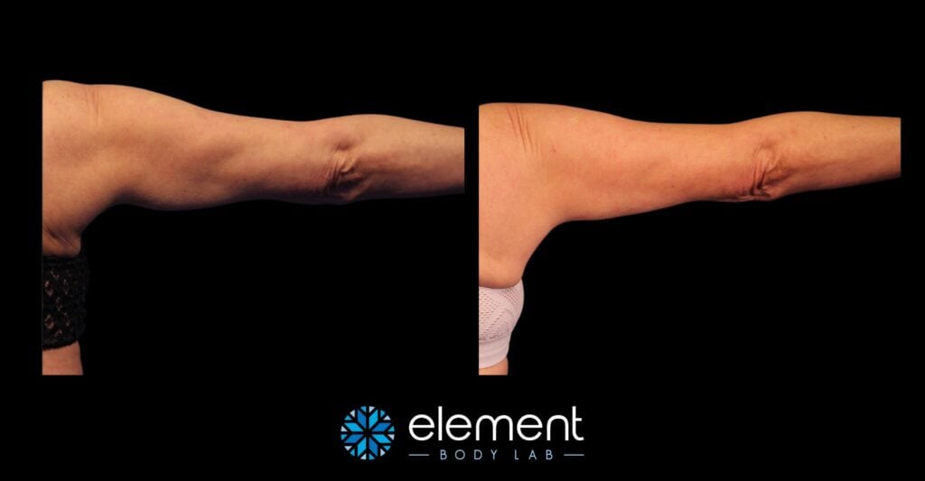 coolsculpting arm before and after photo