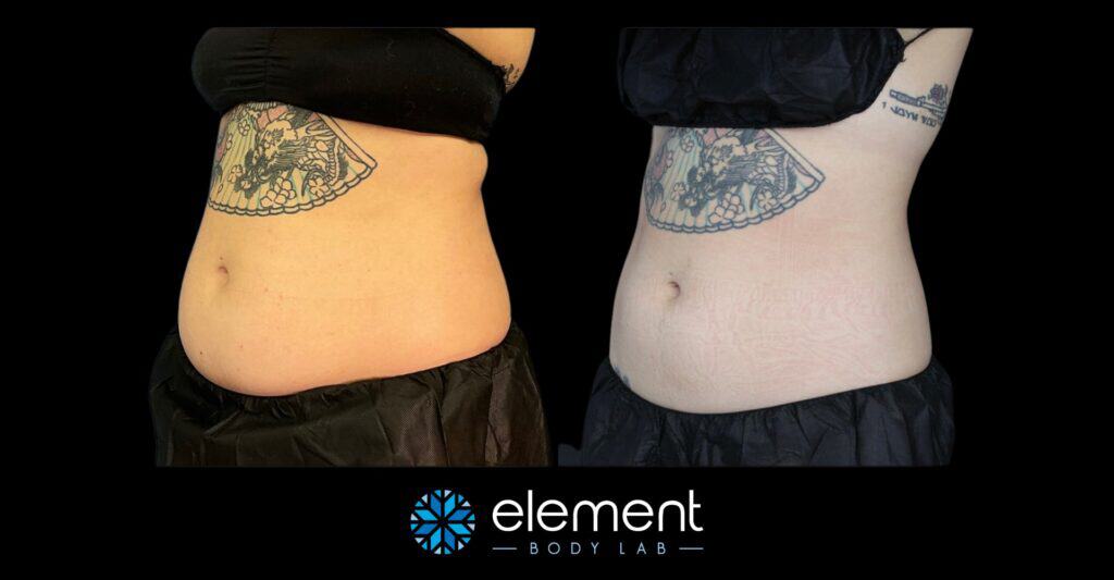 coolsculpting belly fat results from Element Body Lab