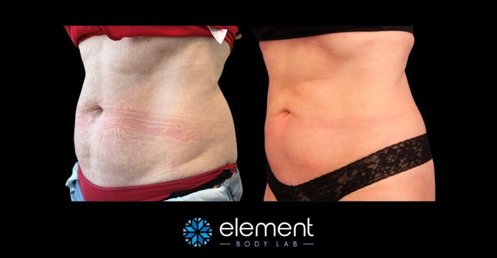 female client coolsculpting results to stomach