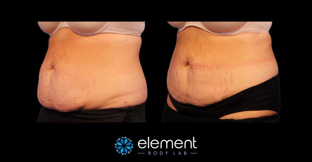 Before and After Results CoolSculpting with skin laxity for client considering coolsculpting vs tummy tuck