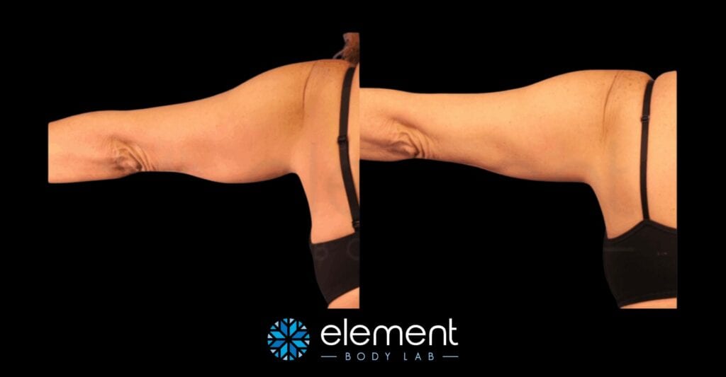 coolsculpting upper arm before and after results