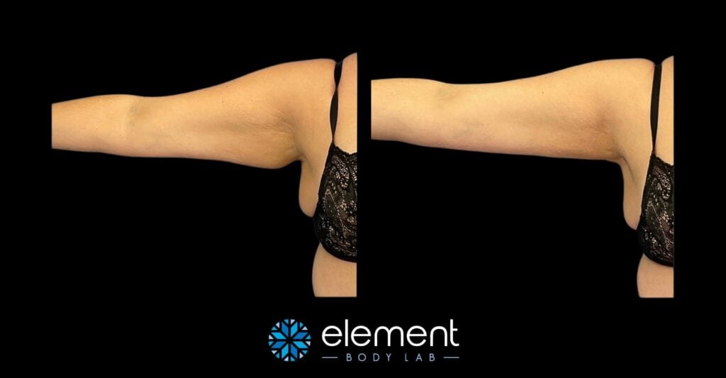 coolsculpting upper arm results on female client