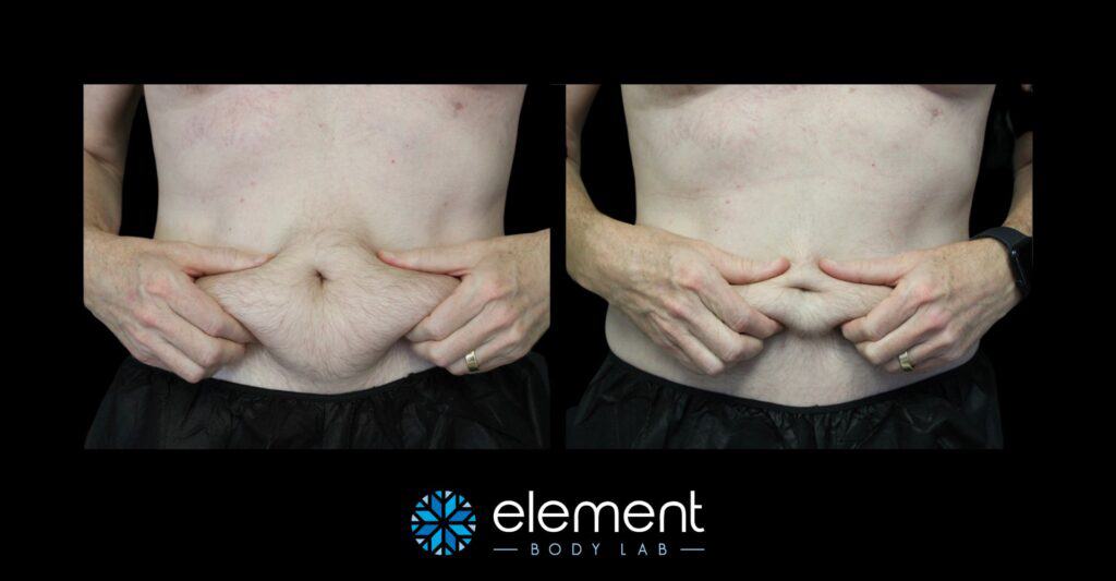 Male CoolSculpting Results on abdomen - man pinching fat on stomach before and after coolsculpting
