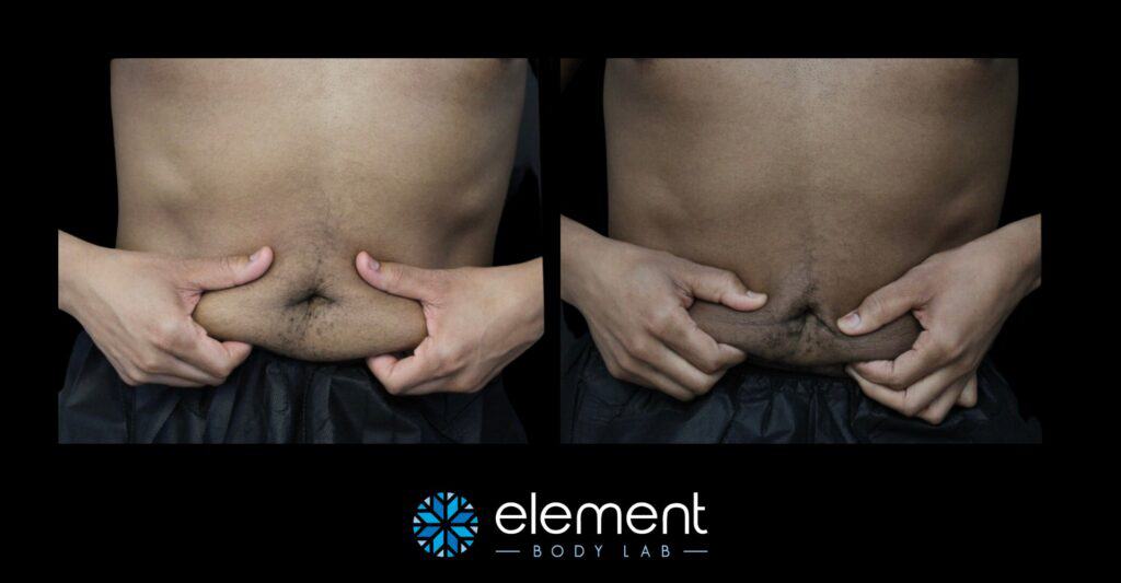 CoolSculpting men's stomach results