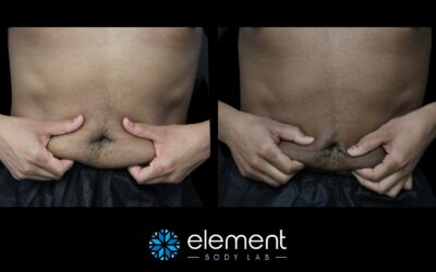 Does CoolSculpting Work On Belly Fat?
