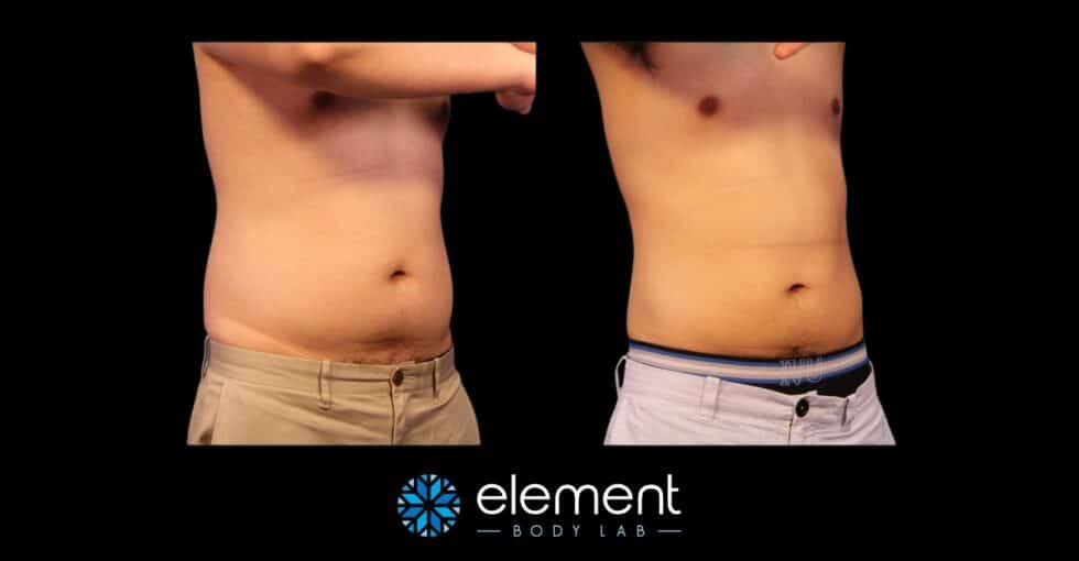 CoolSculpting Before and After Photos | Element Body Lab