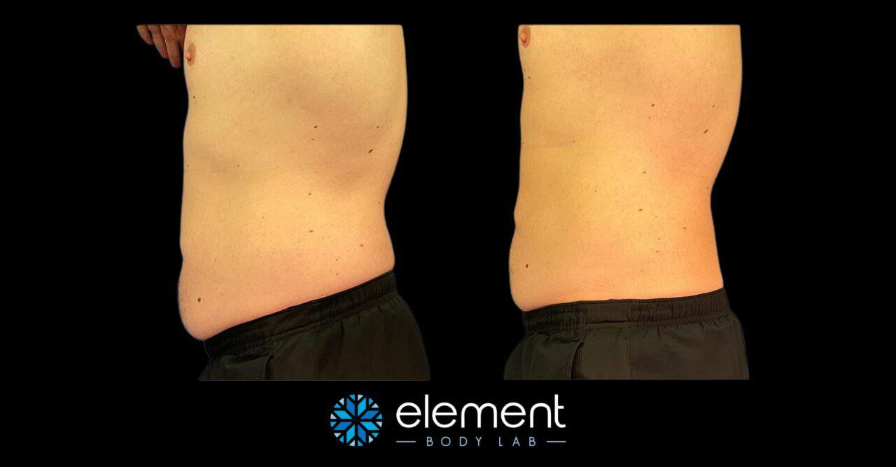 CoolSculpting Before and After Photos | Element Body Lab
