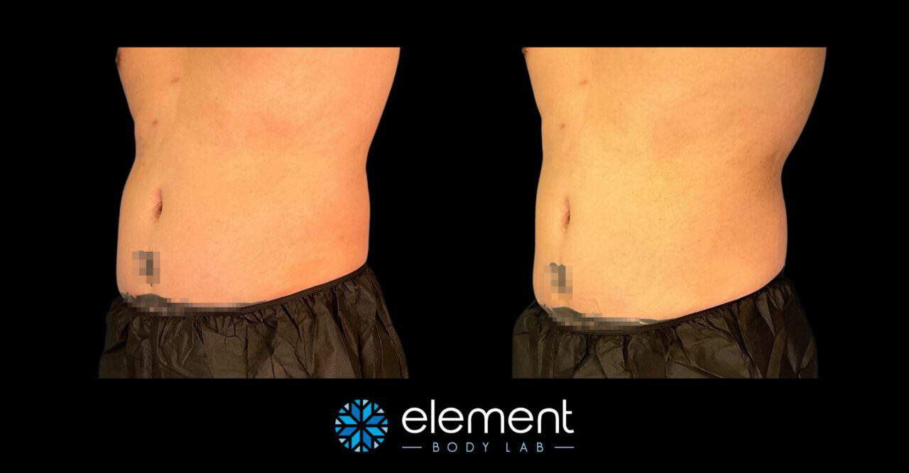 CoolSculpting Before and After Photos | Element Body Lab