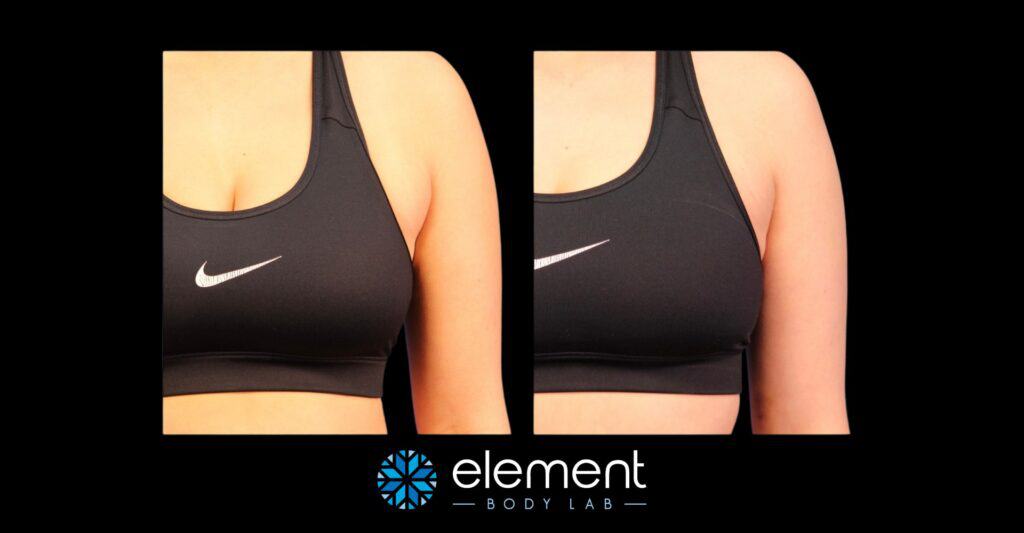 CoolSculpting Armpit Fat  Discover Details for CoolSculpting Under Arms in  Texas - Element Body Lab