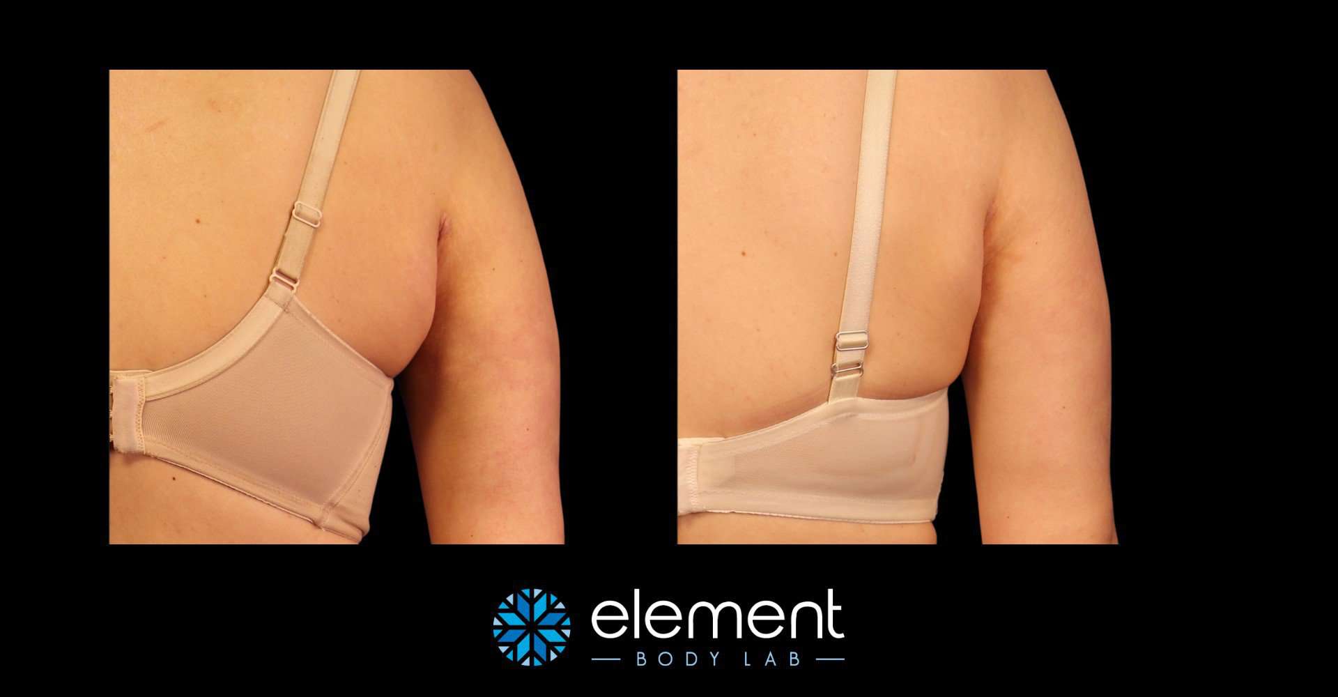 Real Life transformations in our No Back Fat Bra - Before