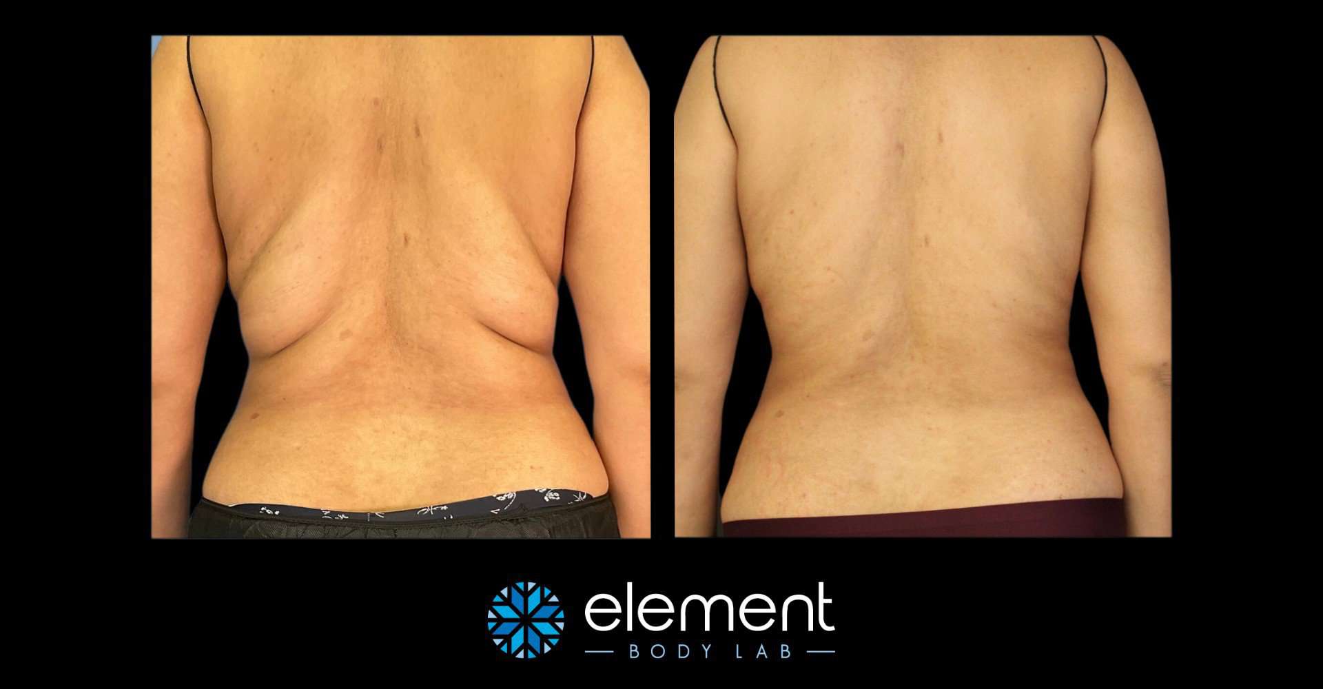 CoolSculpting Before And After Gallery - Element Body Lab