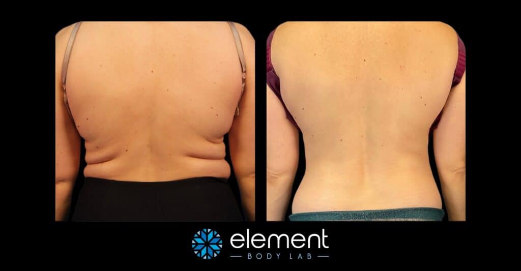 CoolSculpting Results for Back Fat and Love Handles on Female Client