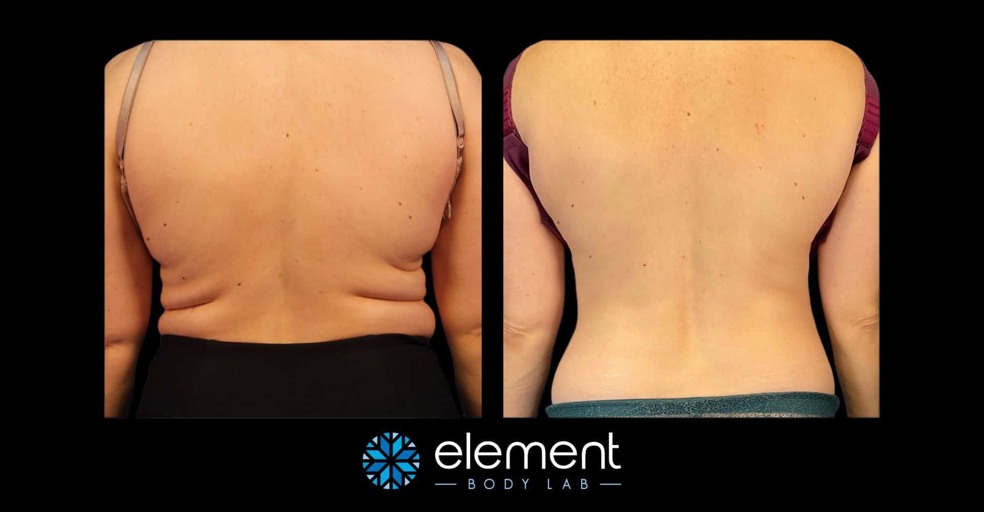 CoolSculpting to Reduce Back Fat