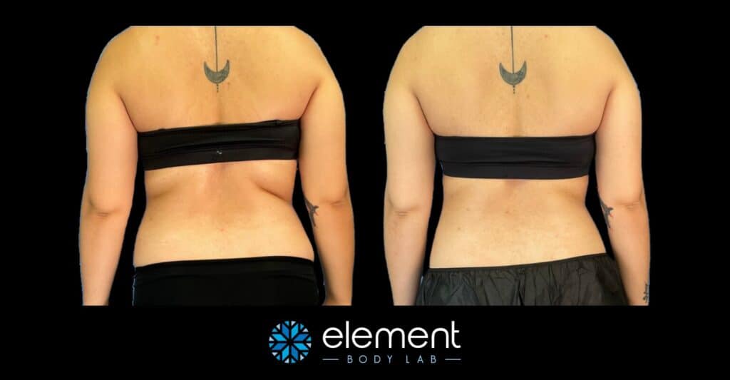 Back/bra fat coolsculpting before and after at Element Body Lab