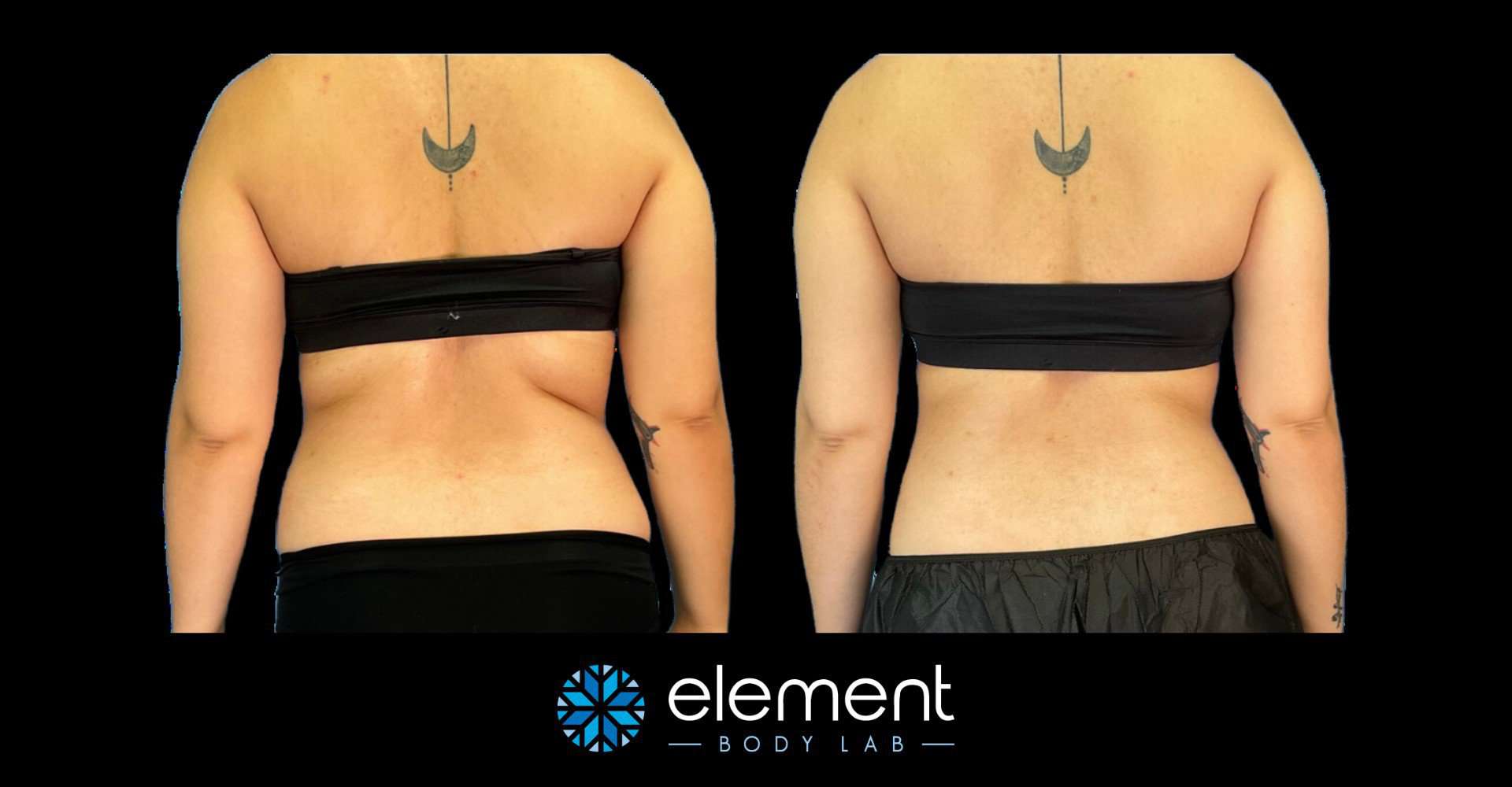 CoolSculpting Armpit Fat  Discover Details for CoolSculpting Under Arms in  Texas - Element Body Lab