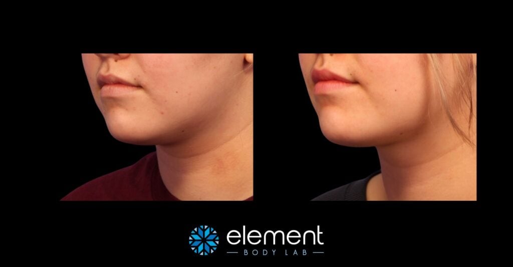 coolsculpting results on female chin 