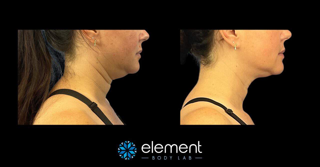 Chin CoolSculpting in Dallas, TX | Element Body Lab