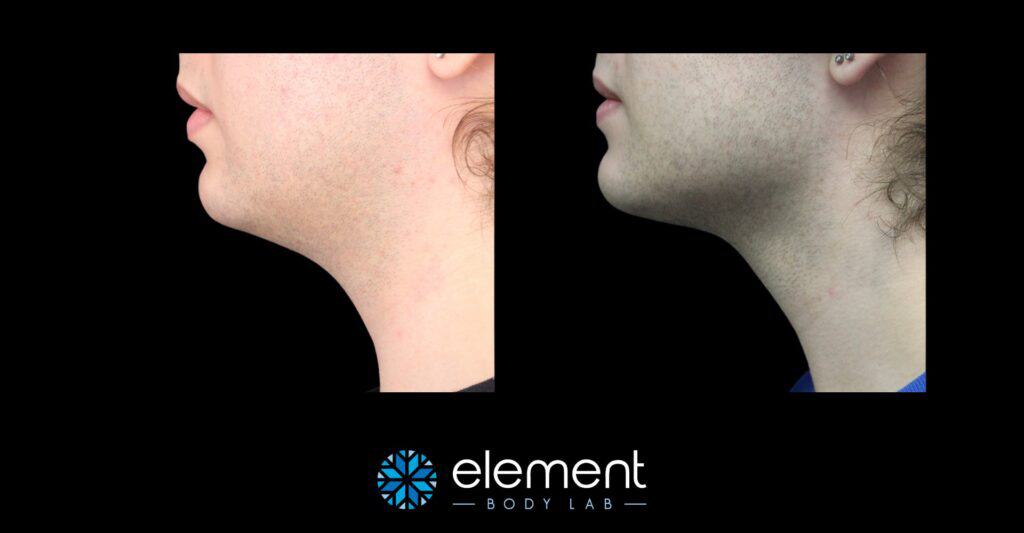 coolsculpting jawline results male client before and after photo