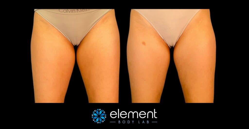 Inner thigh coolsculpting before and after at Element Body Lab