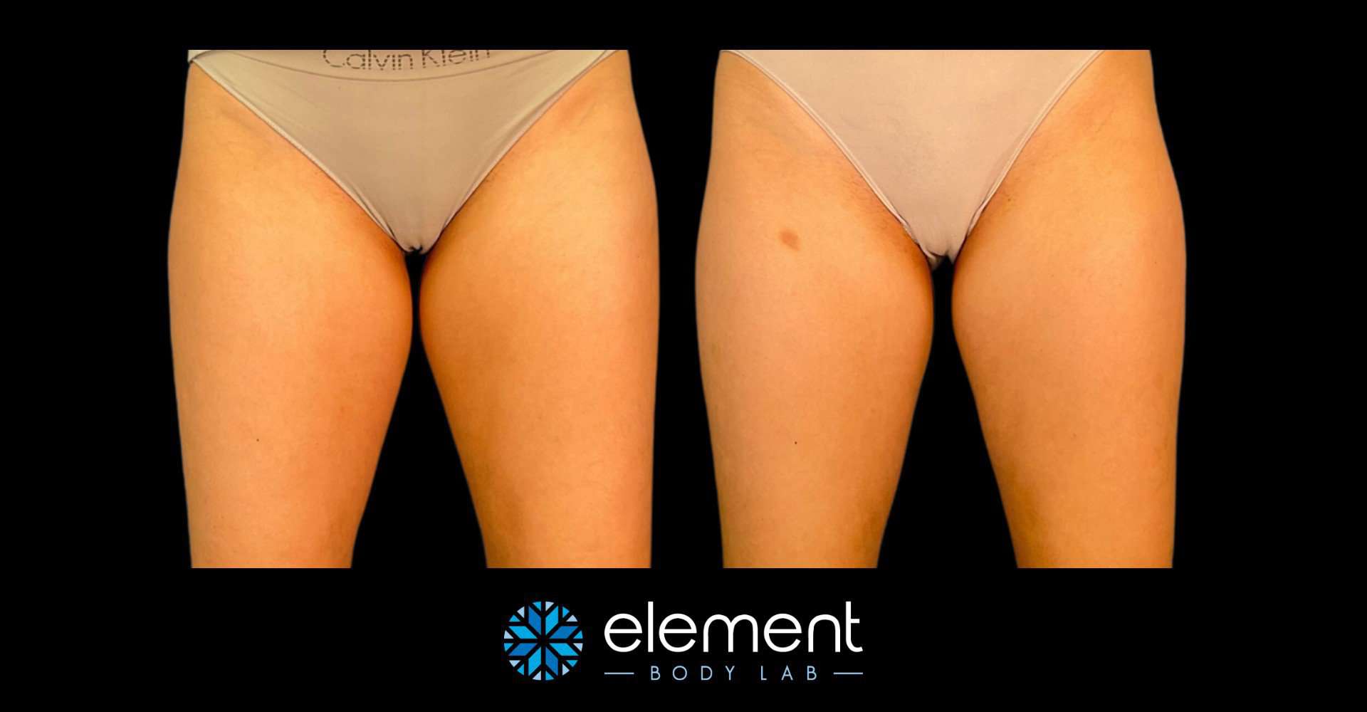 CoolSculpting Thighs in Dallas, TX: Sculpt your Ideal Legs - Element Body  Lab