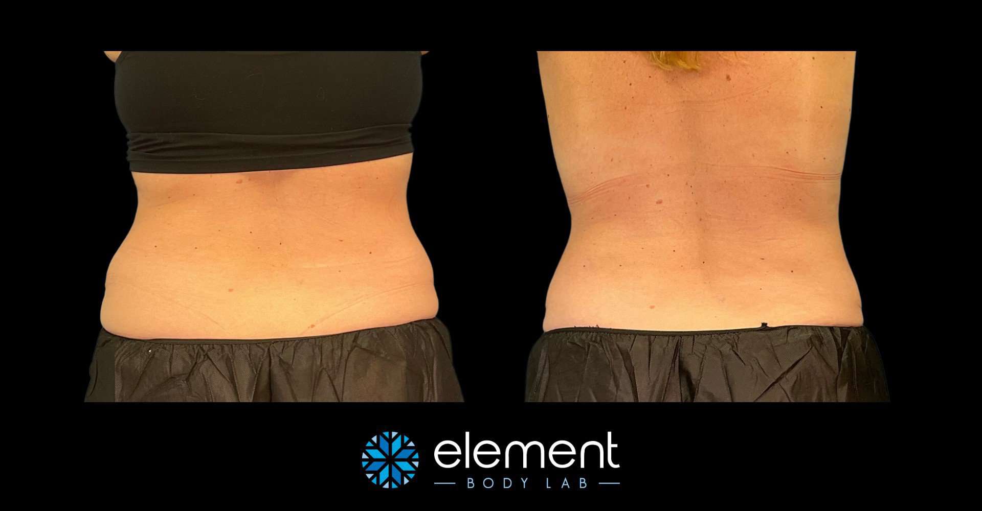CoolSculpting Love Handles, Coolsculpting flanks before and after photos,  liposuction love handles