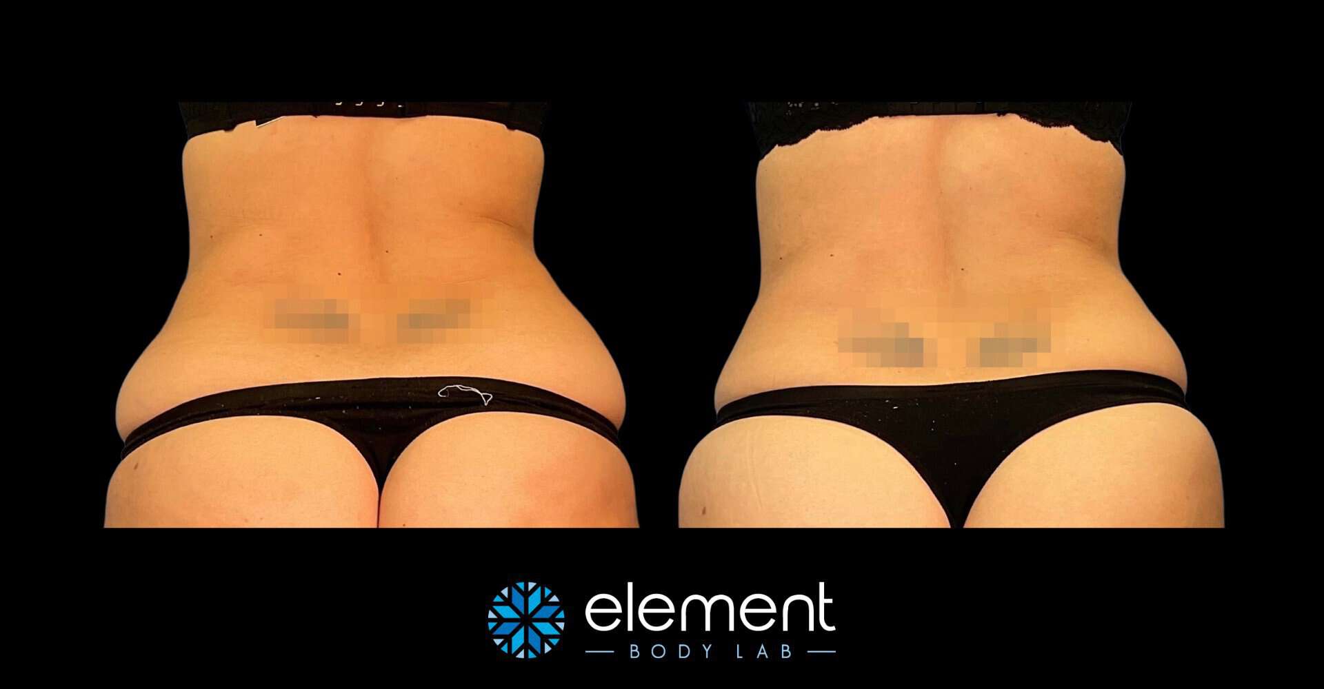 Female love handle coolsculpting before and after at Element Body Lab