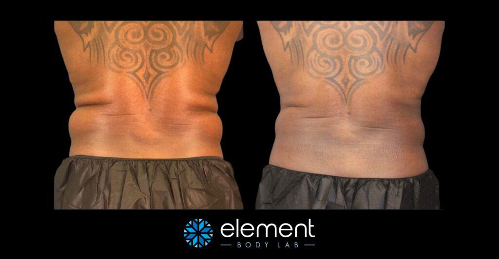 coolsculpting results of black male client love handles