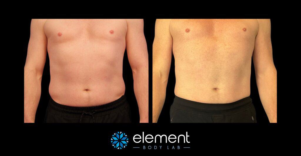 coolsculpting before and after results for male client abdomen and love handles