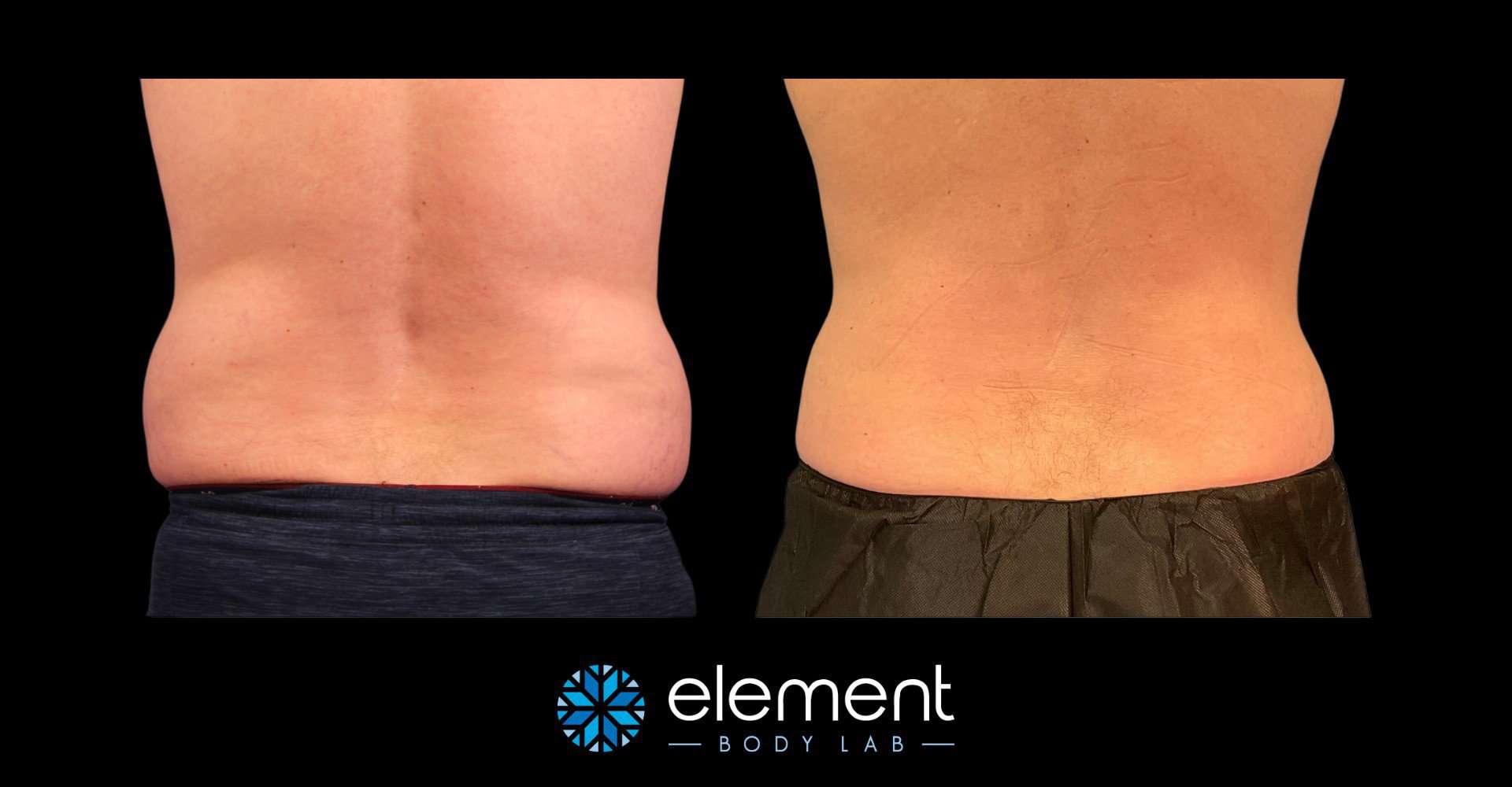 CoolSculpting Love Handles, Coolsculpting flanks before and after