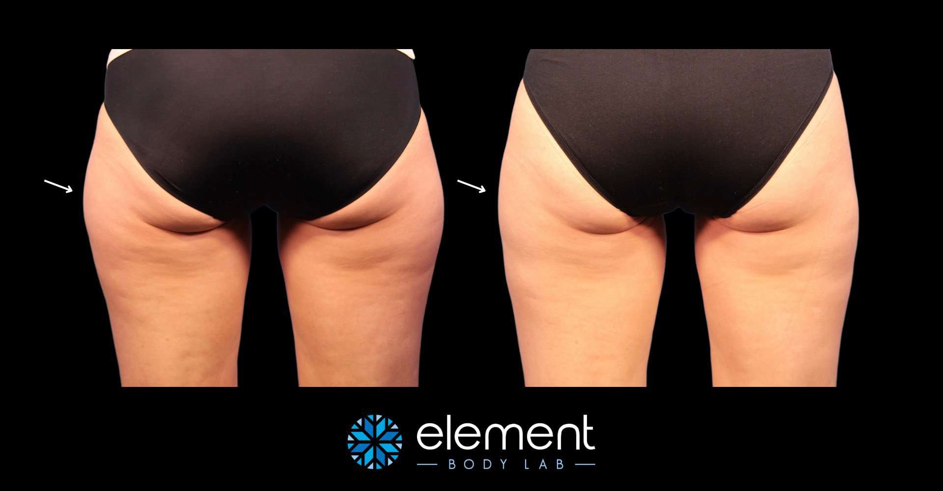 CoolSculpting Thighs in Dallas, TX: Sculpt your Ideal Legs - Element Body  Lab