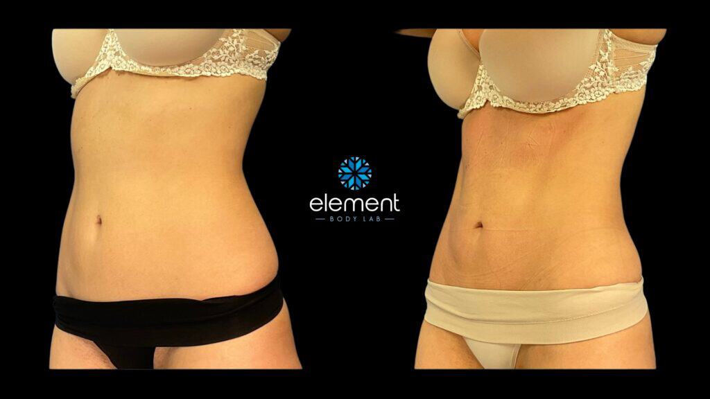 CoolSculpting and CoolTone combo treatment results on abdomen