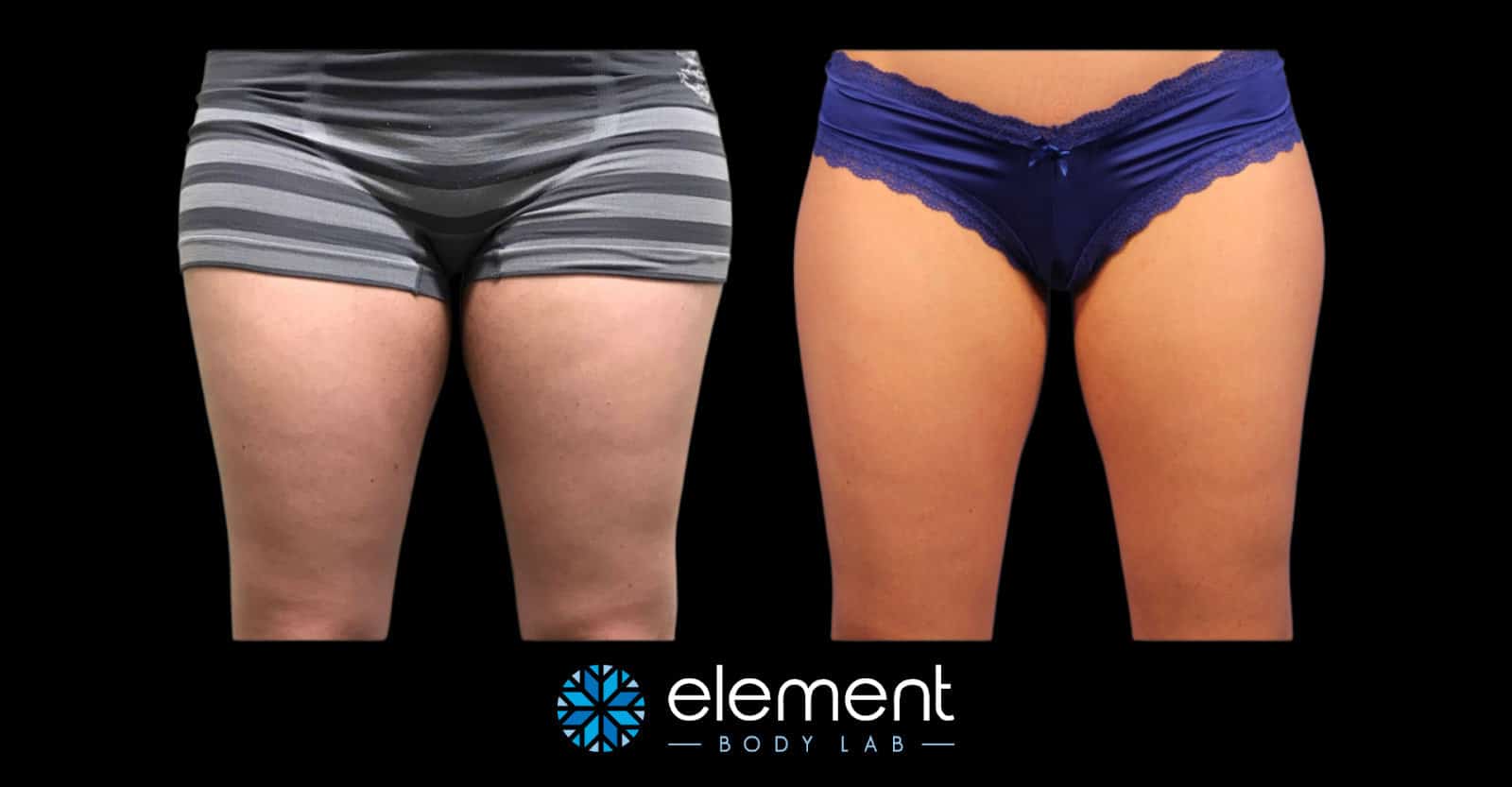 before and after photo of CoolSculpting thigh results