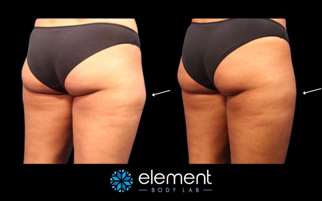 CoolSculpting Cellulite: Does It Work? | Element Body Lab