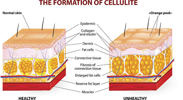 diagram showing the formation of cellulite and comparing normal tissue with orange pee tissue