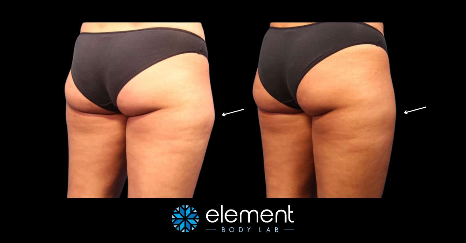 outer thigh coolsculpting results