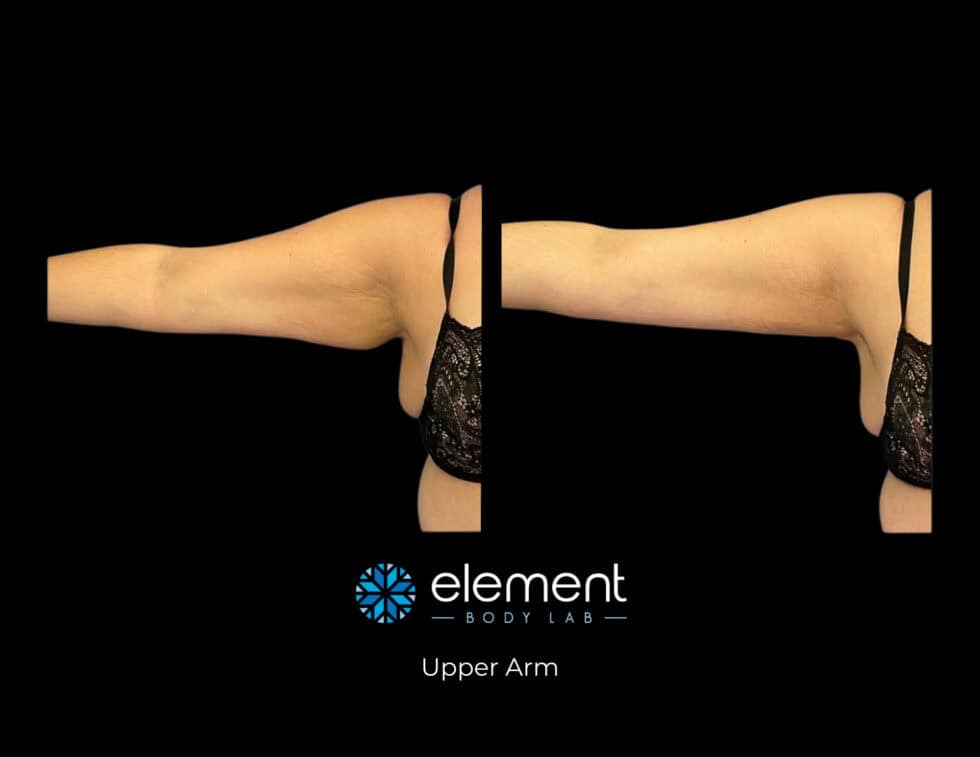 CoolSculpting Before and After Stories (And How to Get Similar Results) Element Body Lab
