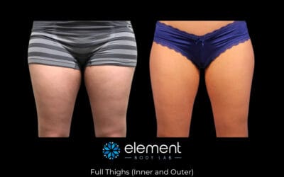 CoolSculpting Before and After Stories (And How to Get Similar Results)